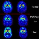 Lee más sobre el artículo La antimateria del PET