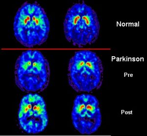 Lee más sobre el artículo La antimateria del PET
